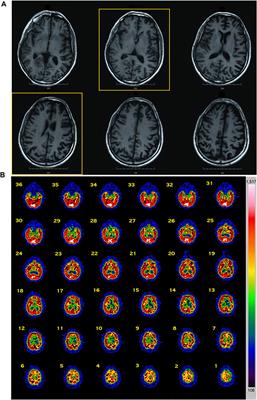 A Novel Mutation (D395A) in Valosin-Containing Protein Gene Is Associated With Early Onset Frontotemporal Dementia in an Italian Family